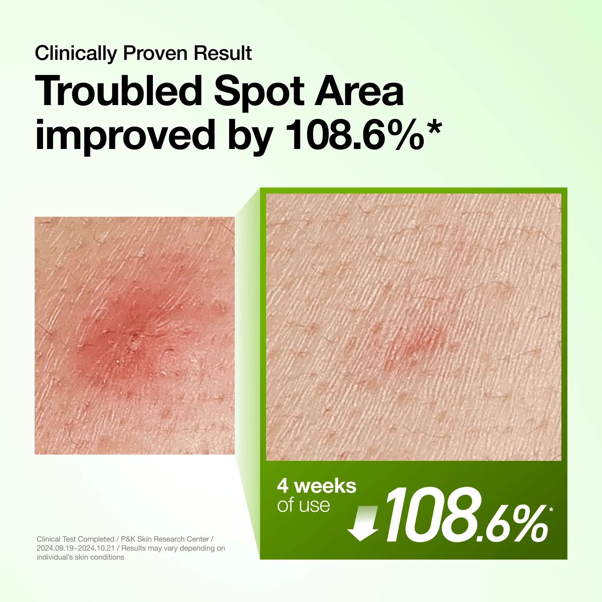 ANUA | Azelaic Acid 10 Hyaluron Redness Soothing Serum 30 ml